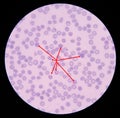 Malaria. Normal and infected red blood cells. Malaria is a disease caused by a parasite called Plasmodium that is spread to human Royalty Free Stock Photo