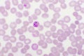 Malaria parasite in red blood cells