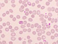 Malaria parasite in red blood cells