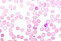 Malaria parasite in red blood cells