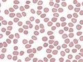 Malaria.Ring forms of plasmodium falciparum in peripheral blood.