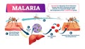 Malaria vector illustration. Mosquito bite blood infected disease