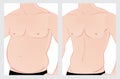 Male abdomen before and after treatment