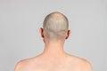 Male alopecia. A man with a bald head. Rear view. Gray background. Copy space Royalty Free Stock Photo