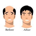 Male baldness pattern stages set. Royalty Free Stock Photo