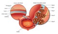 Male bladder Cancer