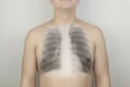 Conceptual photo. Male chest x-ray. An image of the ribs and lungs appeared on the skin of the patient back. View of bones through Royalty Free Stock Photo