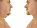 Male double chin correction before and after procedures Royalty Free Stock Photo