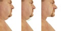 Male double chin correction before and after sagging treatment procedures Royalty Free Stock Photo