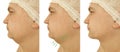 Male double chin removal before collage after treatment procedures Royalty Free Stock Photo