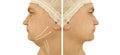Male double chin removal before after treatment procedures Royalty Free Stock Photo
