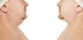 Male double chin tightening collage problem treatment mature before and after procedures Royalty Free Stock Photo