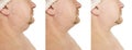 Male double chin tightening problem mature before and after procedures Royalty Free Stock Photo