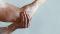 Male arm affected by blistering rash because of monkeypox or other viral infection on grey background Royalty Free Stock Photo