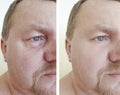 Male eyes wrinkles bloating before treatment after procedures