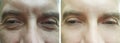 Male eyes wrinkles before after revitalization treatment beautician