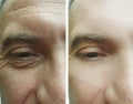 Male eyes wrinkles before after treatment beautician