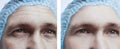 Male eyes wrinkles before and after treatment