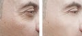 male face removal wrinkles biorevitalization before and after treatments