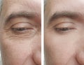 male face removal wrinkles effect biorevitalization before and after treatments