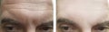 Male face wrinkles removal aging forehead before and after treatment effect Royalty Free Stock Photo