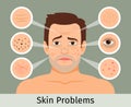 Male facial skin problems Royalty Free Stock Photo