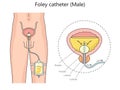 Male foley catheter diagram medical science