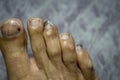 Male foot with fungal infection toenails Royalty Free Stock Photo