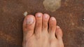 Male Foot with second toe longer than a big toe. Mortons`s toe, Greek foot or Royal toe or Aboriginal feet.