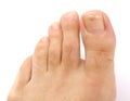 Male foot and toes with damaged nail isolated