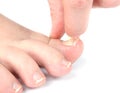 Male foot and toes with damaged nail