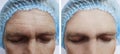 Male forehead wrinkles before and after  biorevitalization cosmetology treatment Royalty Free Stock Photo