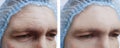 Male forehead correction  wrinkles before and after treatment Royalty Free Stock Photo