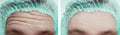 Male forehead wrinkles before and after cosmetology treatment Royalty Free Stock Photo