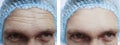 Male forehead  wrinkles before and after treatment Royalty Free Stock Photo