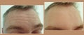 Male forehead wrinkles before  after treatment Royalty Free Stock Photo