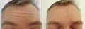 Male forehead wrinkles before after treatment treatment Royalty Free Stock Photo