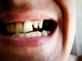 The male grinded his teeth for porcelain crowns or veneers