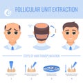 Transplantation with FUE in men Royalty Free Stock Photo