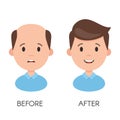 Male hair loss