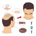 FUT transplantation hair loss medical treatment poster Royalty Free Stock Photo