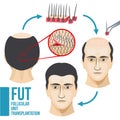 Male hair loss treatment medical vector infographic Royalty Free Stock Photo