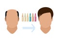 Male hair loss treatment. Before and after stages of hair growth procedure on face silhouette. Alopecia infographic Royalty Free Stock Photo