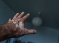 The male hand is affected by vitiligo. Health. Royalty Free Stock Photo