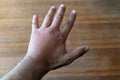 Male hand stung by bee or wasp. Hand swelling, inflammation, redness are signs of infection. Insect bite on left hand on wooden Royalty Free Stock Photo