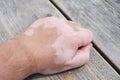 Male hand with vitiligo skin condition