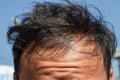 Male head with thinning hair or alopecia, balding