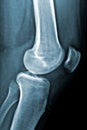 Male left knee radiograph or x-ray image. Medical and healthcare imagery