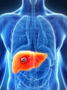 Male liver - cancer