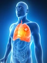 Male lung - cancer Royalty Free Stock Photo